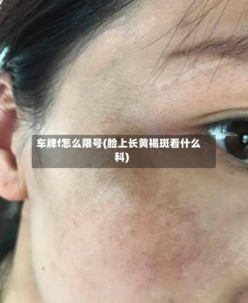 车牌f怎么限号(脸上长黄褐斑看什么科)-第1张图片